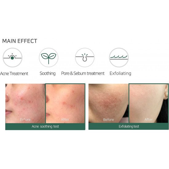 منظف الوجه الرغوي لحب الشباب المعجزة 30 يوما من سوم باي مي - 100مل