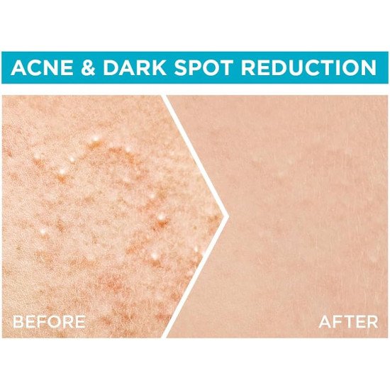 سيروم غارنييه سكين أكتيف فاست كلير بوستر للوجه، للبشرة مع حمض الساليسيليك، 15 مل