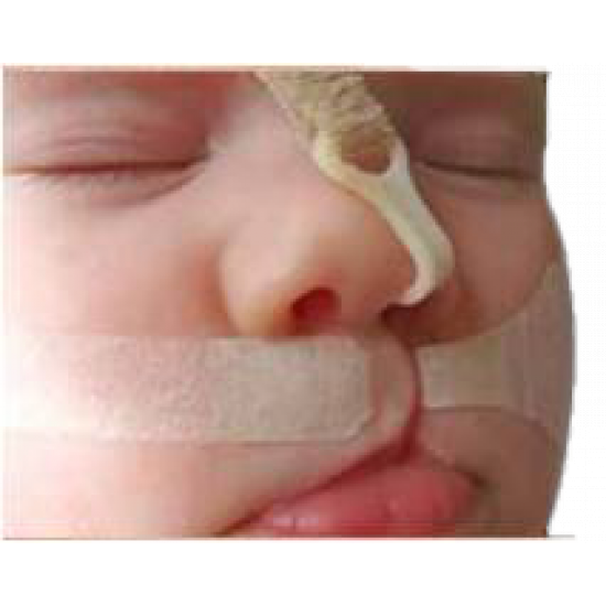 اداة لشد الانف خاصة بالشفة الارنبية