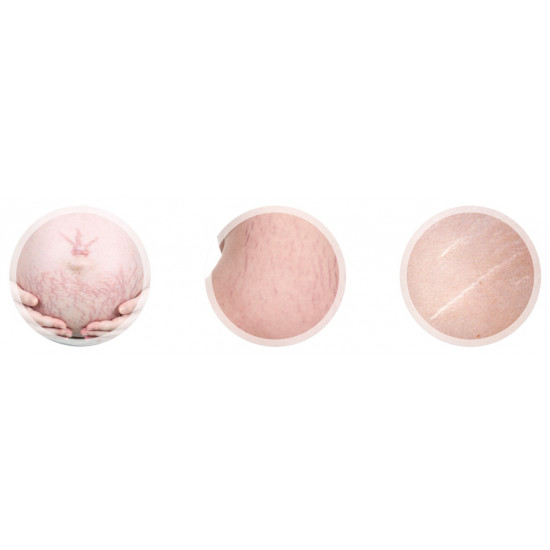 ستراتامارك جل سيليكون غير ممتص للجلد مصمم لمنع وعلاج جميع أنواع علامات التمدد في الجلد الناتجة عن:  • الحمل • طفرات نمو المراهقين • تكبير الثدي • زيادة الوزن أو كمال الأجسام حجم 20 جرام 