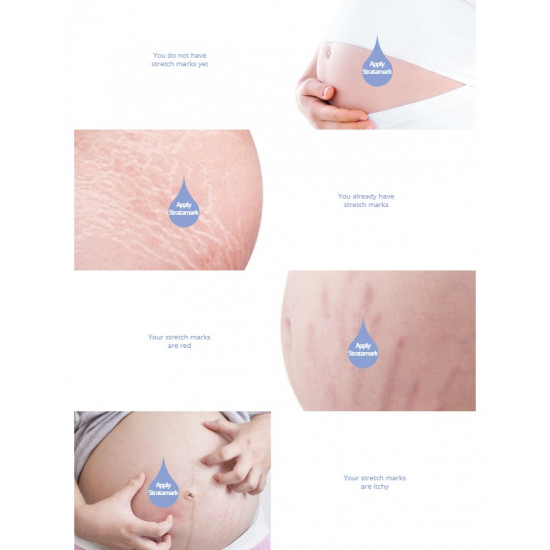 ستراتامارك جل سيليكون غير ممتص للجلد مصمم لمنع وعلاج جميع أنواع علامات التمدد في الجلد الناتجة عن:  • الحمل • طفرات نمو المراهقين • تكبير الثدي • زيادة الوزن أو كمال الأجسام حجم 20 جرام 