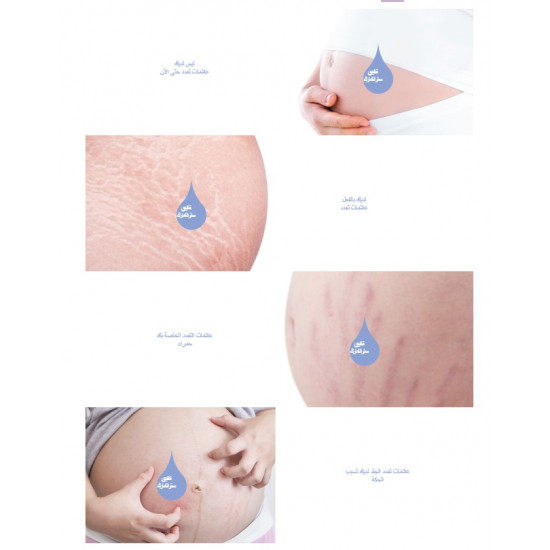 ستراتامارك جل سيليكون غير ممتص للجلد مصمم لمنع وعلاج جميع أنواع علامات التمدد في الجلد الناتجة عن:  • الحمل • طفرات نمو المراهقين • تكبير الثدي • زيادة الوزن أو كمال الأجسام حجم 20 جرام 