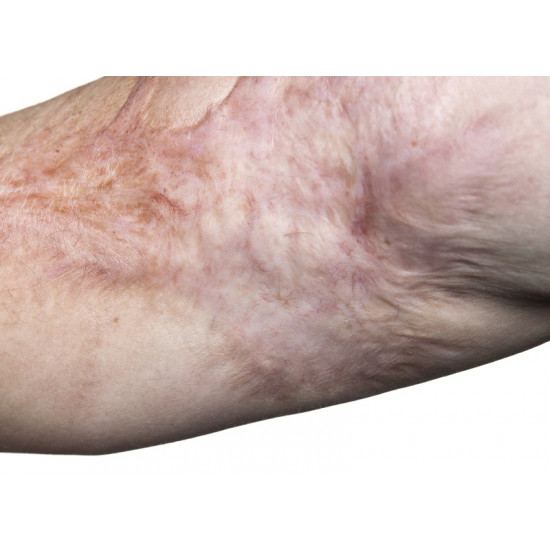 ستراتامارك جل سيليكون غير ممتص للجلد مصمم لمنع وعلاج جميع أنواع علامات التمدد في الجلد الناتجة عن:  • الحمل • طفرات نمو المراهقين • تكبير الثدي • زيادة الوزن أو كمال الأجسام حجم 20 جرام 