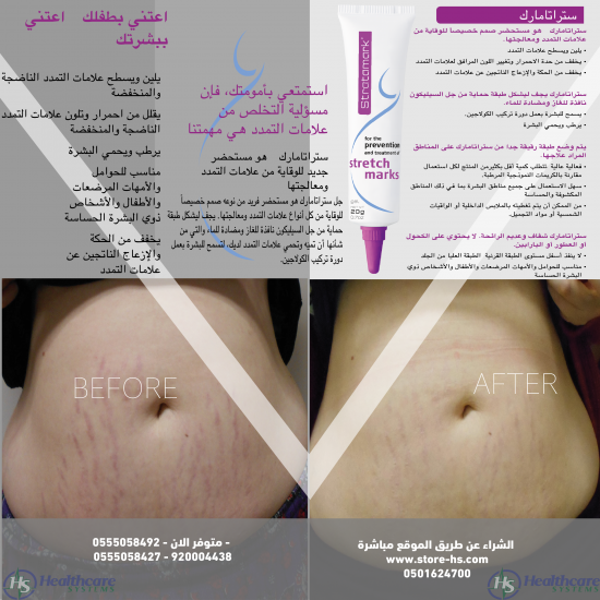 ستراتامارك جل سيليكون غير ممتص للجلد مصمم لمنع وعلاج جميع أنواع علامات التمدد في الجلد الناتجة عن:  • الحمل • طفرات نمو المراهقين • تكبير الثدي • زيادة الوزن أو كمال الأجسام حجم 20 جرام 