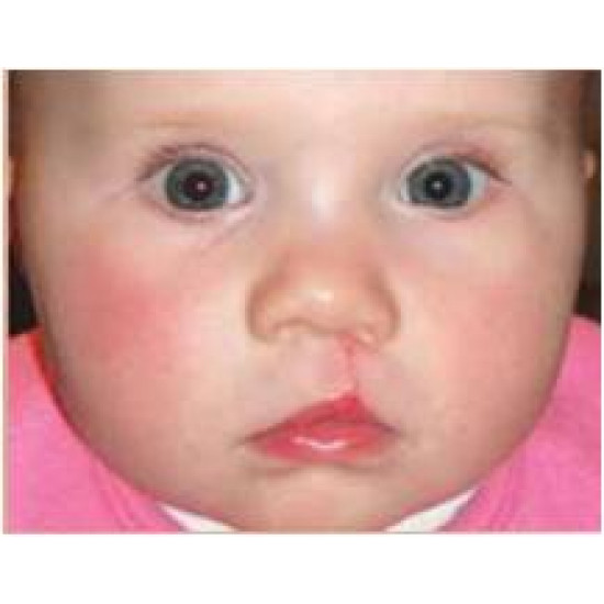 اداة مساعدة خاصة لشفة الارنبية جهة واحدة 