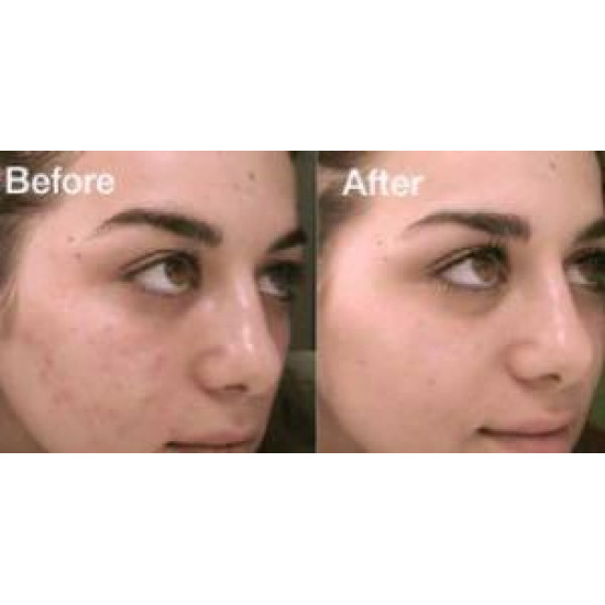 ذا أورديناري سيروم ألفا أربوتين 2% + HA - لعلاج التصبغات (30 مل)