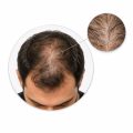 تساقط وفراغات الشعر