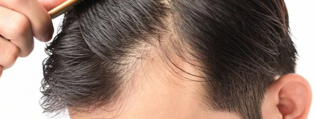 أسباب تساقط الشعر أسباب تساقط الشعر