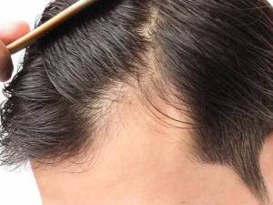 أسباب تساقط الشعر أسباب تساقط الشعر