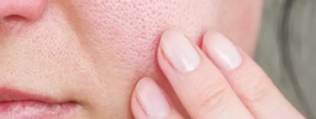 7 Effective Steps to Minimize Enlarged Pores 7 Effective Steps to Minimize Enlarged Pores