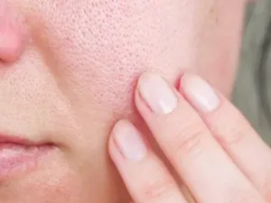 7 Effective Steps to Minimize Enlarged Pores 7 Effective Steps to Minimize Enlarged Pores