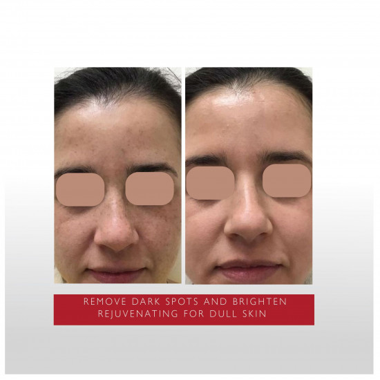 المقشر المركز المقشر المركز