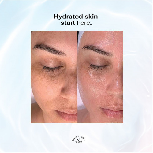 سيروم الهيالورونيك أسيد