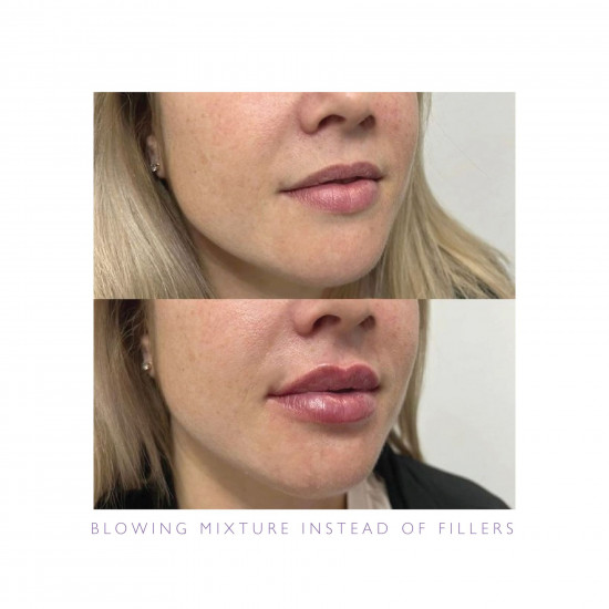 بديل الفيلر بديل الفيلر