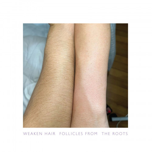 بديل الليزر