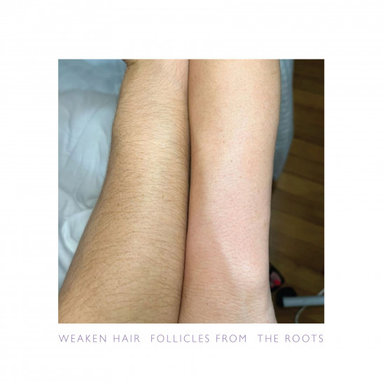 بديل الليزر