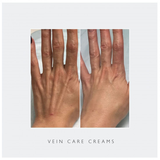 خلطة عروق اليدين