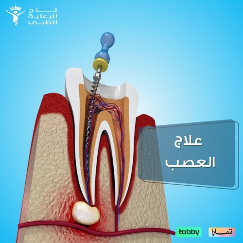 علاج عصب علاج عصب