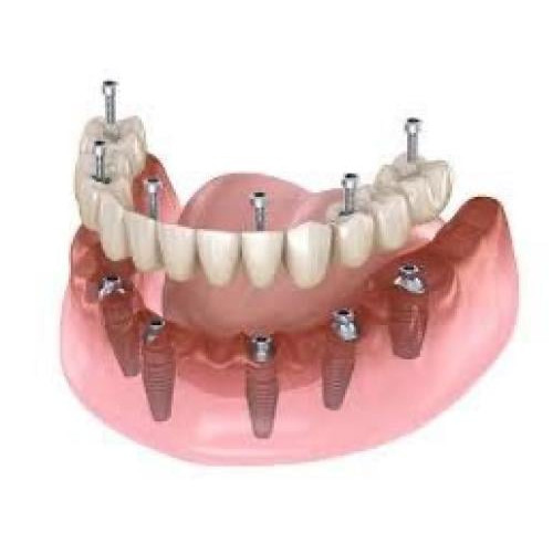 زراعة اسنان