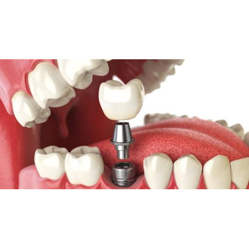 زراعة اسنان زراعة اسنان