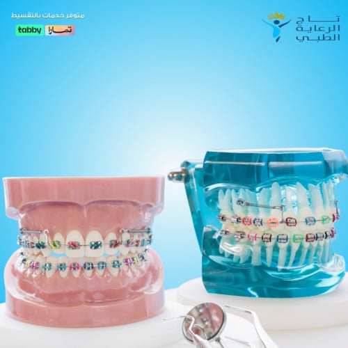 استشارة تقويم اسنان استشارة تقويم اسنان