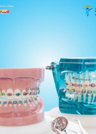استشارة تقويم اسنان