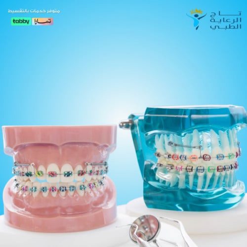 استشارة تقويم اسنان
