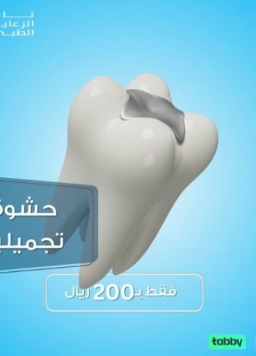 حشوة أسنان اطفال حشوة أسنان اطفال