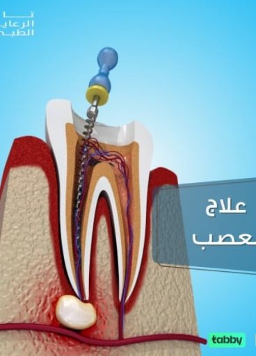 علاج عصب